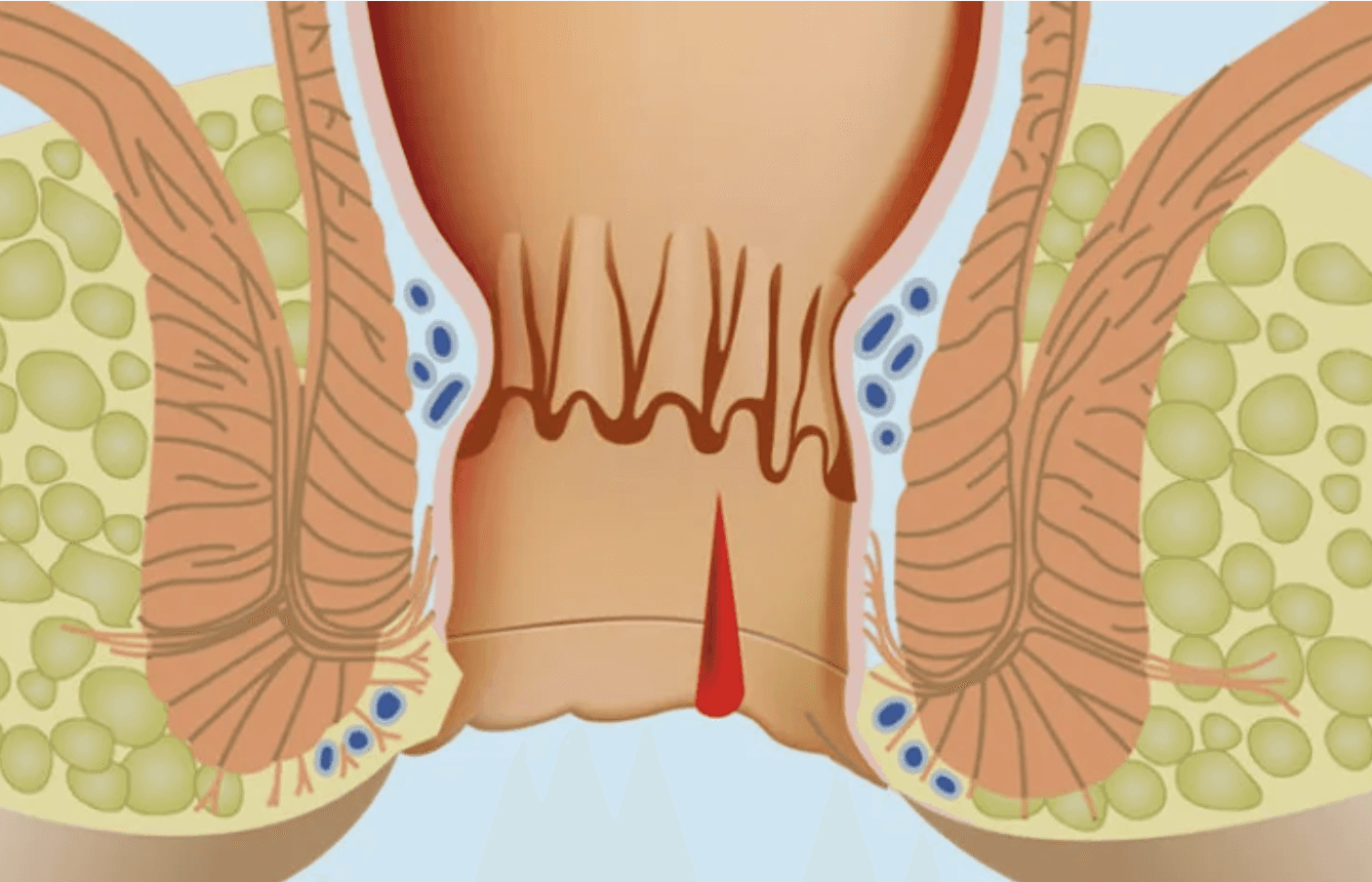 Hemoroid-Kendiliginden-Gecer-mi
