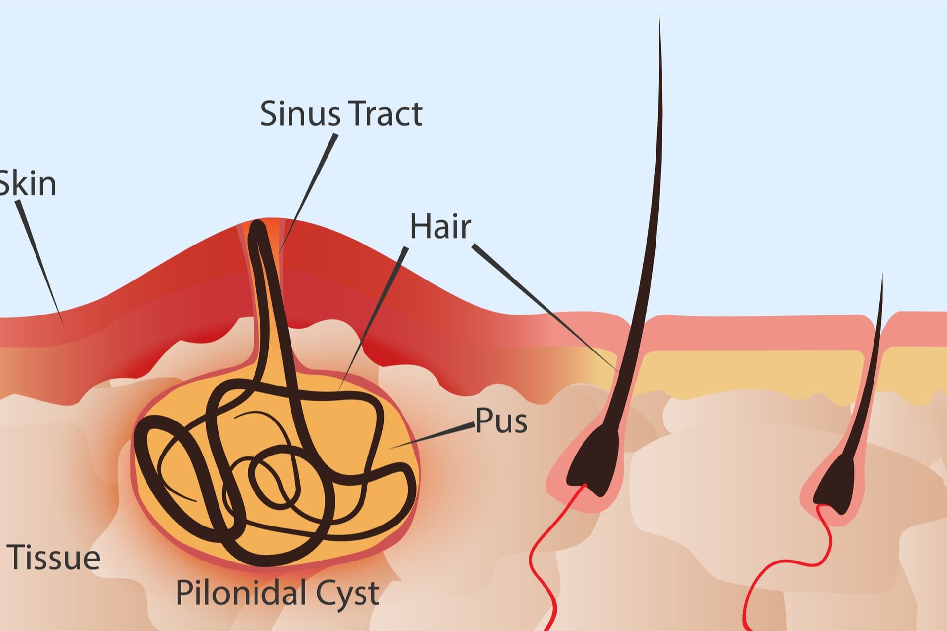 Pilonidal Cyst Treatment: How Long Does the Healing Process Take?