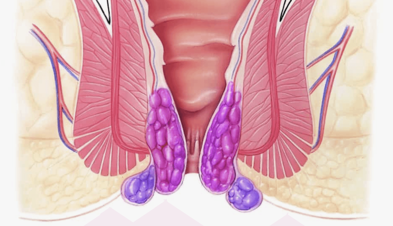 Tromboze-Hemoroid-Nedir