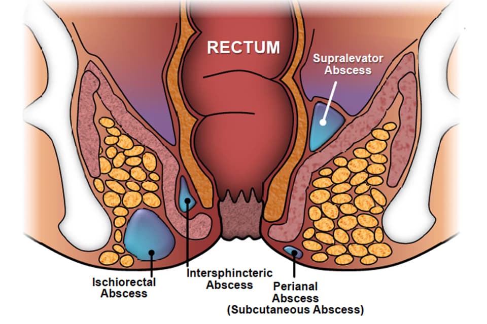 What Helps with an Anal Abscess?