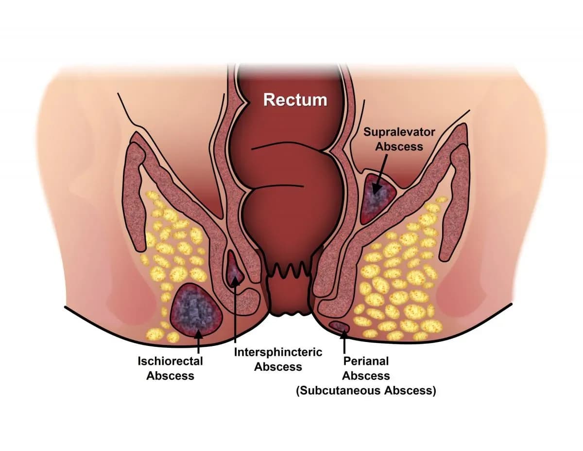 anal_abscess