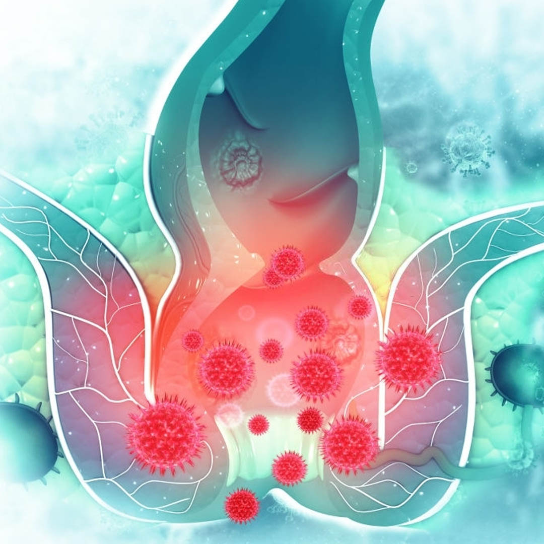 hemoroid-basur-nedir