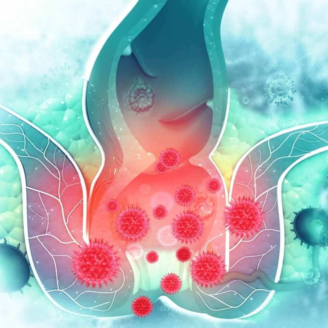 Does anal fistula disappear by itselfs