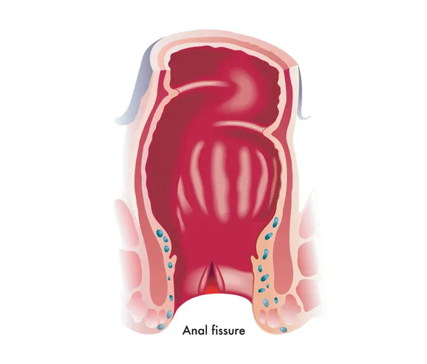 anal fissure