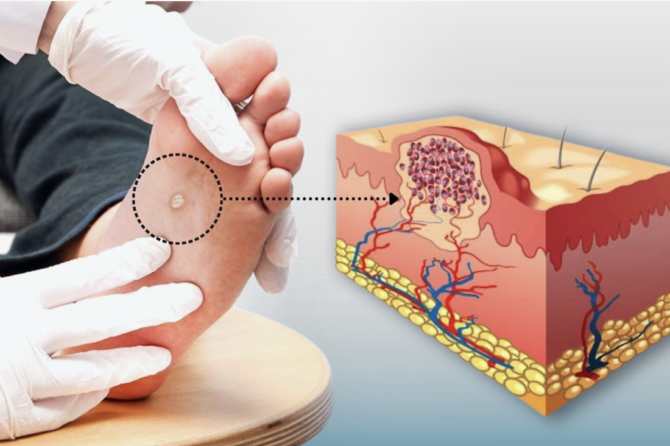 Si të trajtoni lythat pa kirurgji?