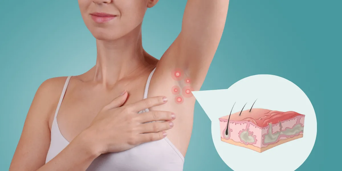 Hidradenitis Suppurativa 