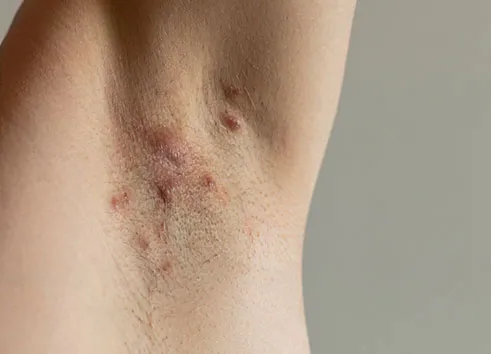 Hidradenitis suppurativa