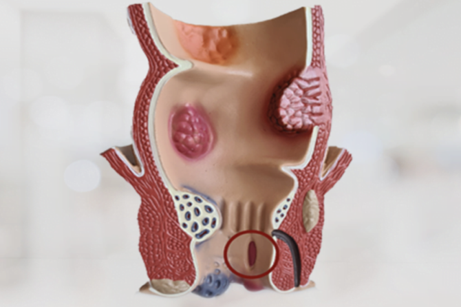 Pse Shfaqet Fistula Anale?