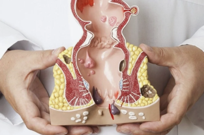 Çfarë ndihmon për trajtimin e fistulës anale? Si mund të eliminohet fistula anale?