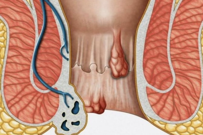 Si formohet fistula anale?