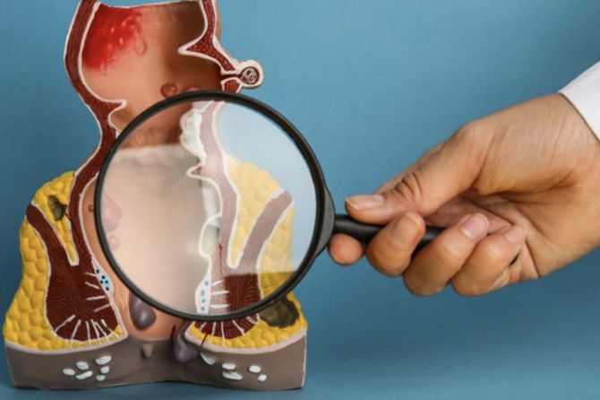 A Mund të Trajtohen Hemorroidet në Shtëpi?