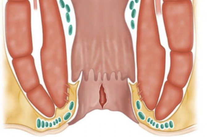 A Ndikojnë Sëmundjet e Anusit në Jetën Seksuale?