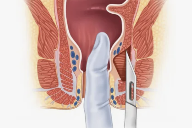 Pse Shfaqet Çarja Anale Kronike?