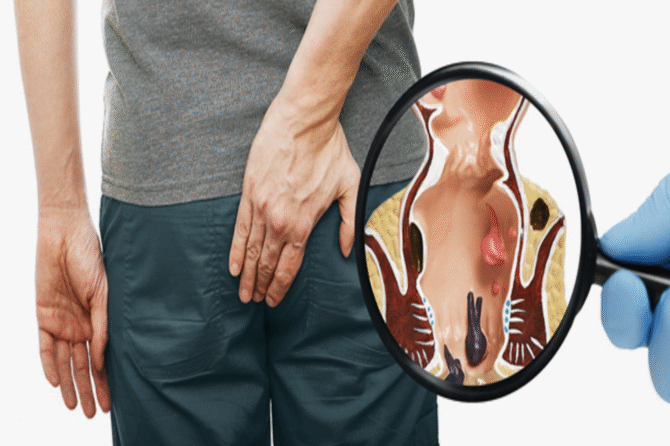 Çfarë janë Metodat e Trajtimit të Mbështetura nga Video (VAAFT) për Fistulën Anale?