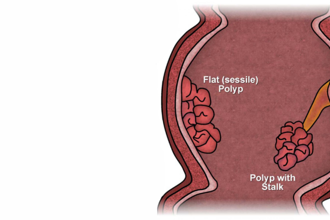 Si Diagnostikohet Polipi Anal? Proçesi i Muajës dhe Diagnozës