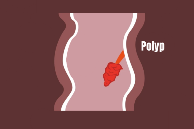 Çfarë është polipi anal? Informacione të rëndësishme rreth polipeve analë dhe perianalë