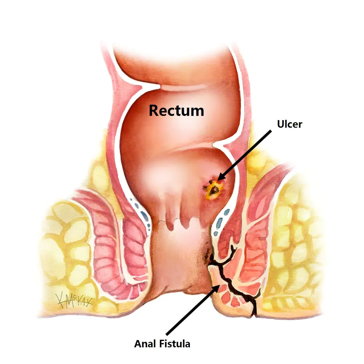 ¿Cómo se forma la fístula anal?