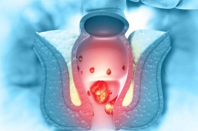 هل تؤثر أمراض الشرج على الحياة الجنسية؟
