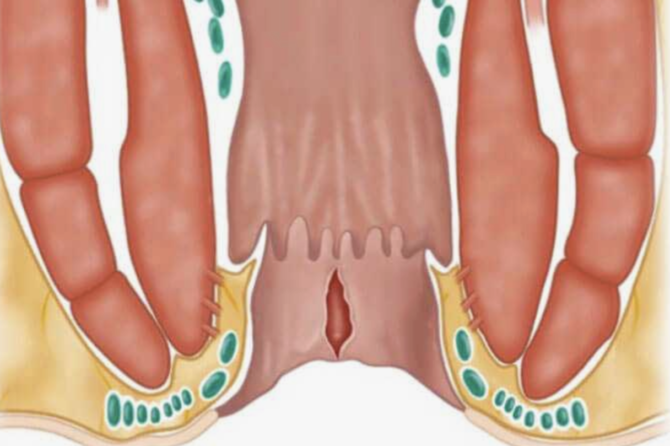 العلاج الطبي للشق الشرجي بالأدوية والمراهم