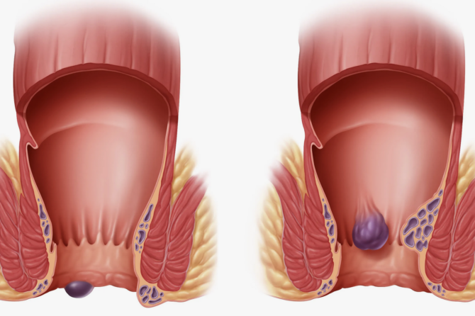 ما هي أفضل طريقة لعلاج البواسير؟