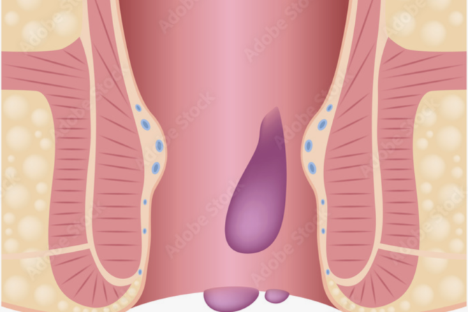 ما الذي يحدث إذا لم تُعالج البواسير؟