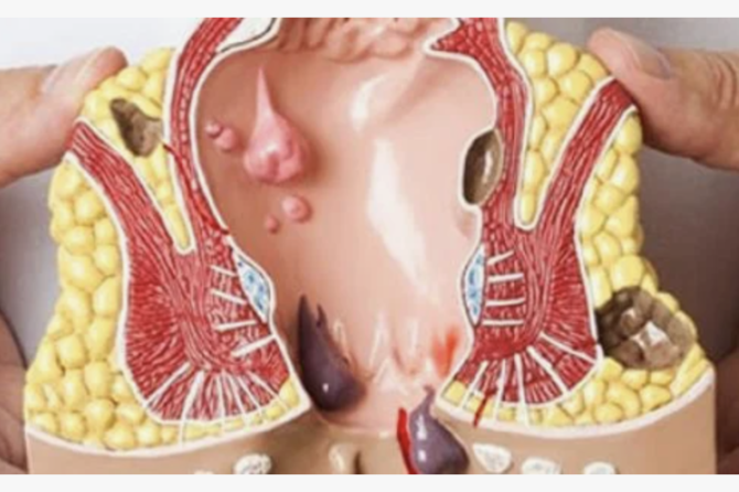 ماذا يجب القيام به عند حدوث الناسور الشرجي