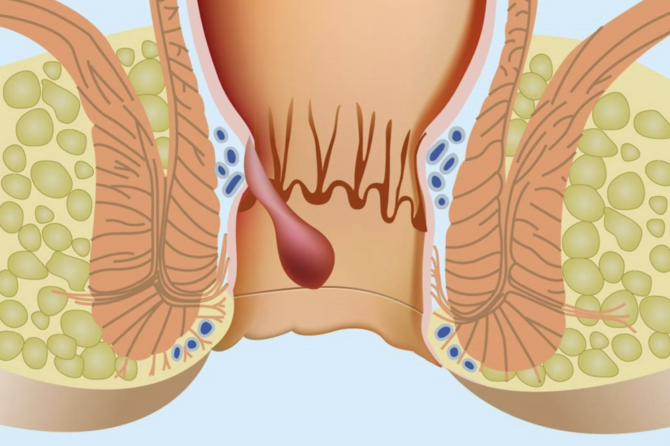 كيف تتكون الناسور الشرجي؟