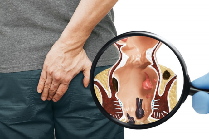 كيفية علاج البواسير بدون جراحة