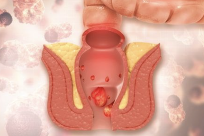 ماذا يحدث إذا لم تُعالج البواسير؟