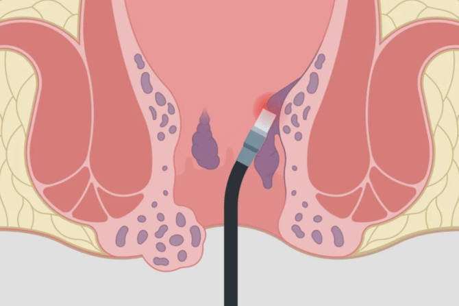 ما هي آخر التطورات في علاج البواسير بالليزر؟