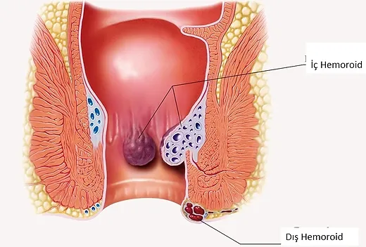 hemoroid