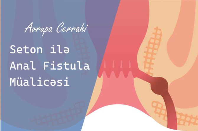 Seton ilə Anal Fistula Müalicəsi
