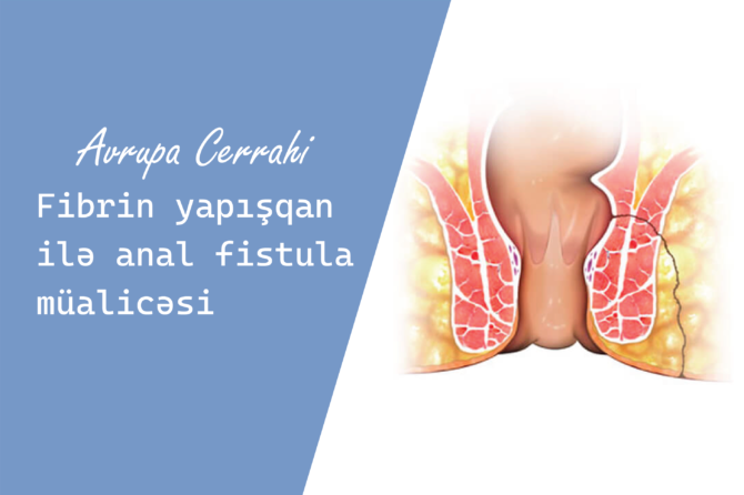 Fibrin yapışqan ilə anal fistula müalicəsi