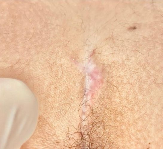 Qıl dönməsi (pilonidal sinus) müalicədən sonra