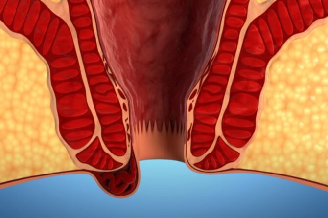 Hemoroidə Nə Yaxşıdır?