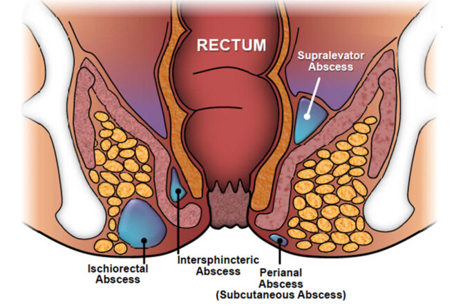 Anal Abse Nə İyi Gəlir?
