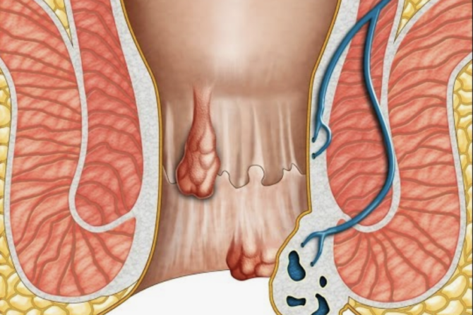 Anus Estetikası Nədir?