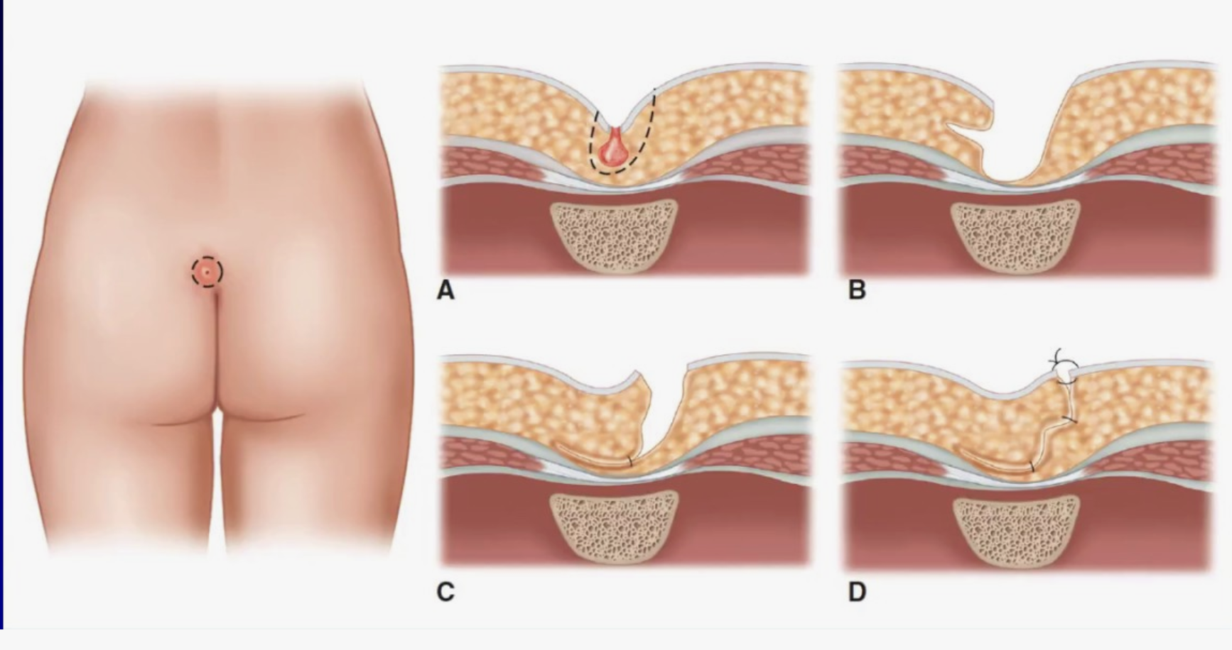 Anus yaqinidagi kadife tamponning fotosurati