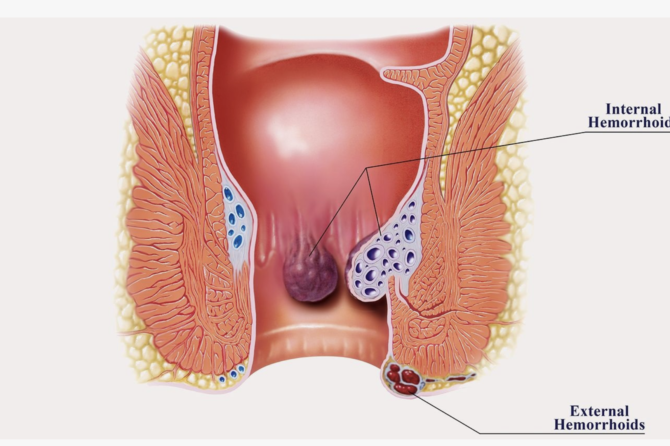Daxili və Xarici Hemoroid Nədir və Fərqləri Nələrdir?
