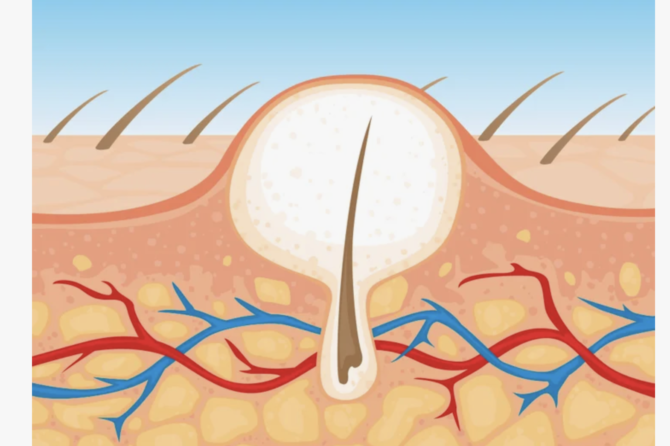 Kıl Dönməsi Müalicə Edilməzsə Nə Olar?