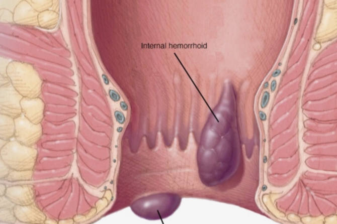 Hemoroidi Əməliyyatsız Necə Müalicə Etmək Olar?