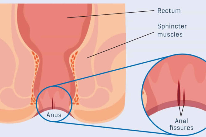 Anal Fissür Necə Ortaya Çıxar?