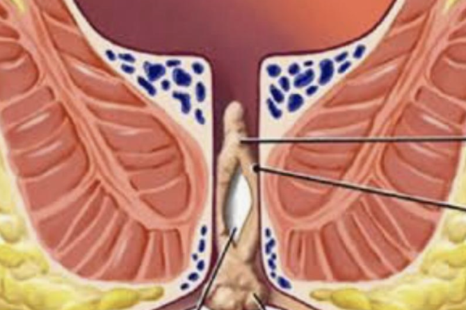 Əməliyyatsız Anal Fistül Müalicəsi Necə Aparılır?