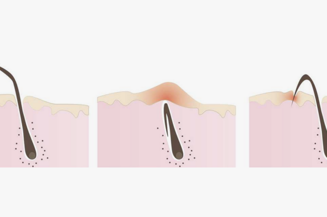 Əməliyyatsız Kıl Dönməsi Müalicəsi Necə Aparılır?