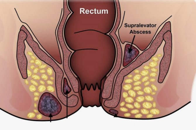 Anal Fistul Niyə Yaranır?