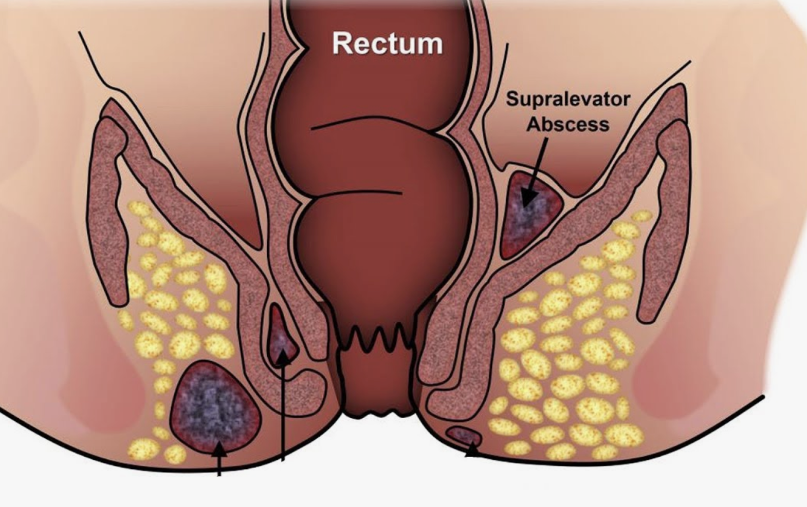 Gipertrofiyalangan anal nipel nima va bu nima? Gipertrofiyalangan anal nipel nima va bu nima?