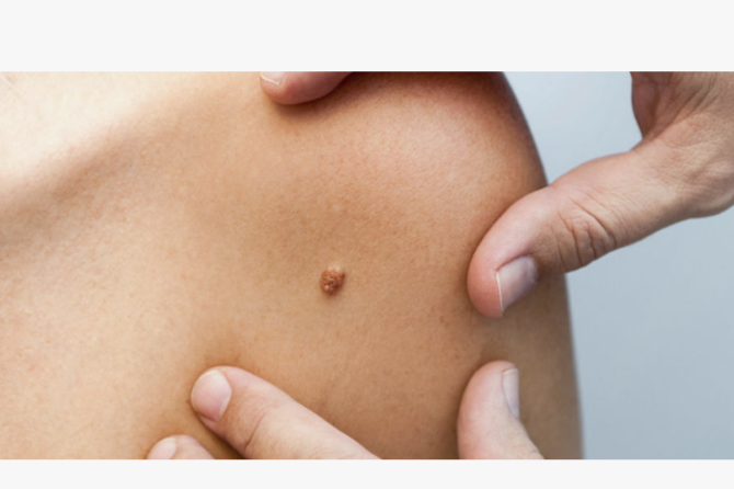 Makat Sığallarının Müalicəsi