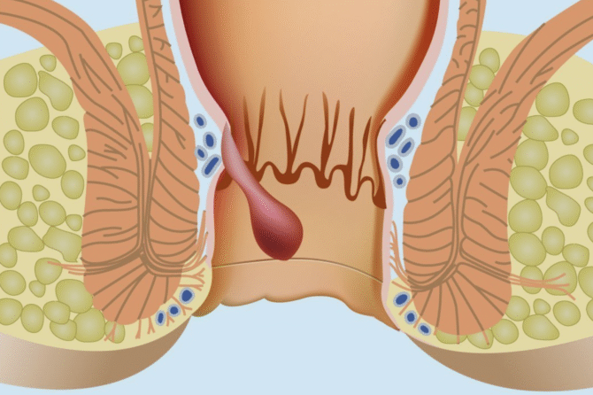 Anal Absesin Müalicəsində Antibiotik Kifayət edirmi?