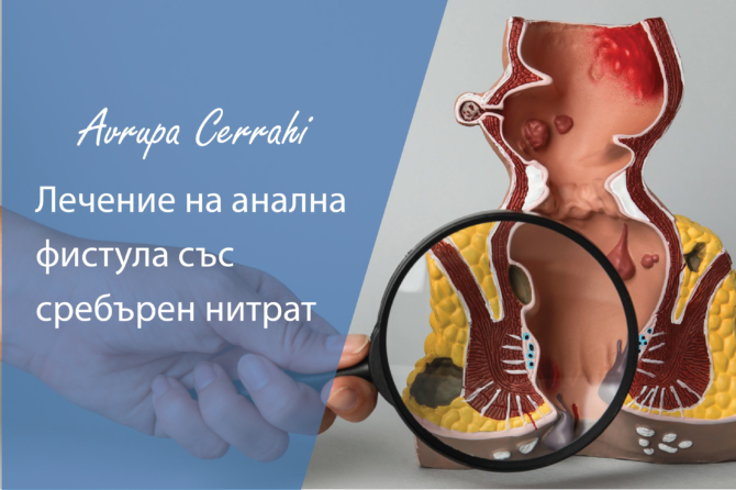 Лечение на анална фистула със сребърен нитрат