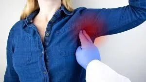 Hidradenitis Suppurativa